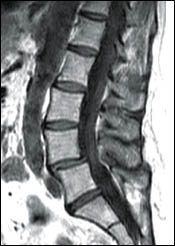 Evaluation of Spinal Instability