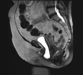 pelvic floor dystrophy